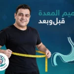 تكميم المعدة قبل وبعد