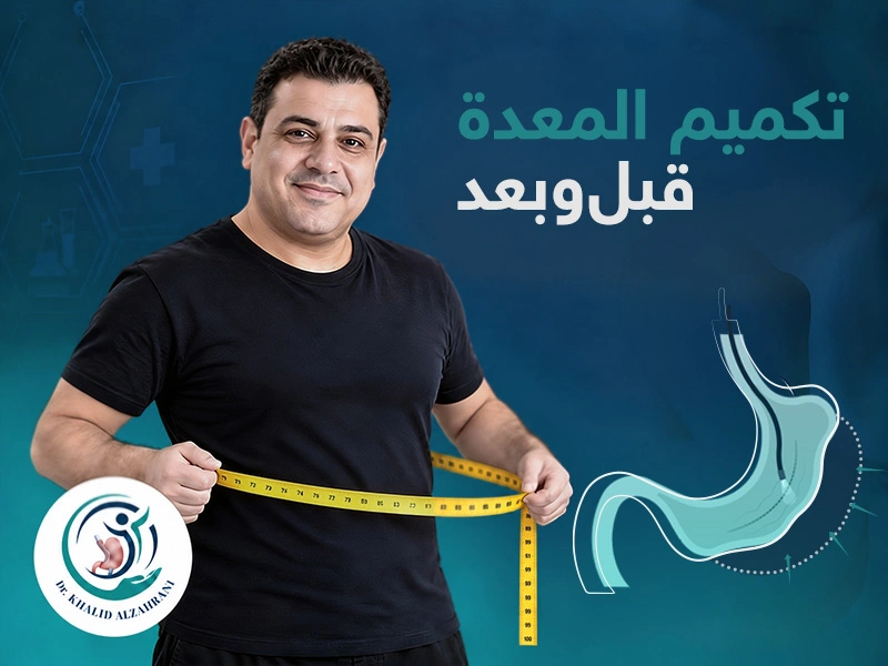 تكميم المعدة قبل وبعد