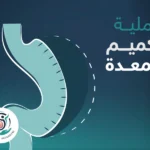 عملية تكميم المعدة