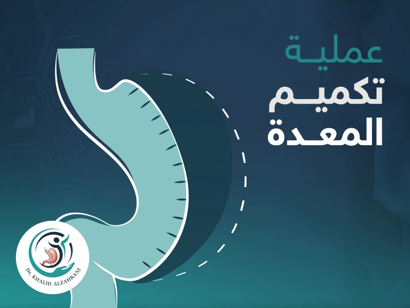 عملية تكميم المعدة