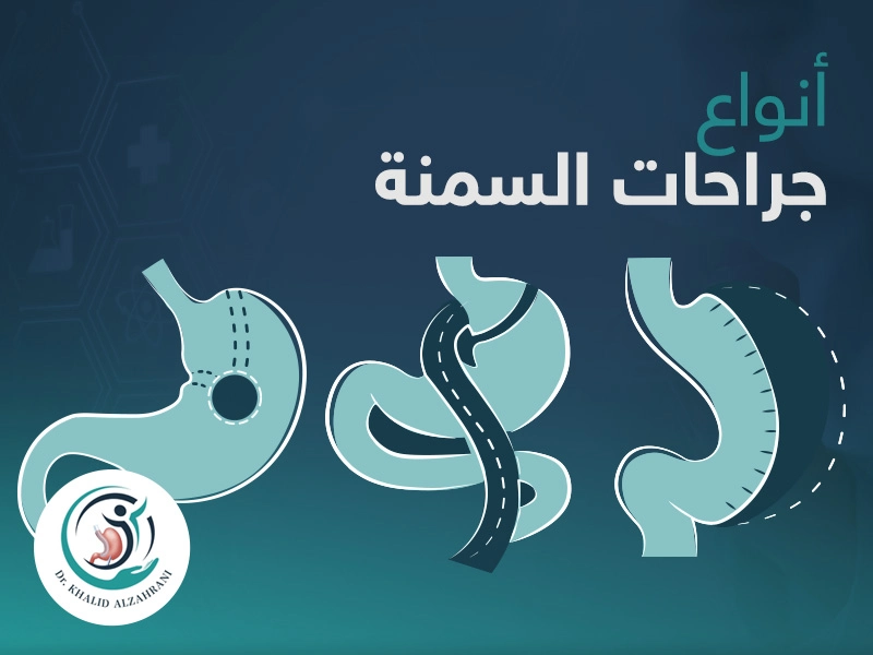 أنواع عمليات السمنة