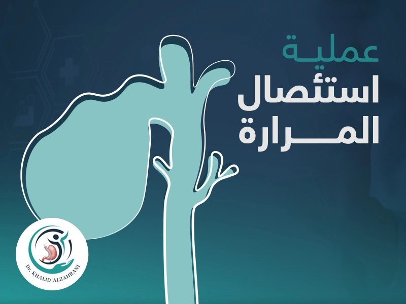عملية استئصال المرارة