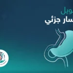 تحويل مسار جزئى