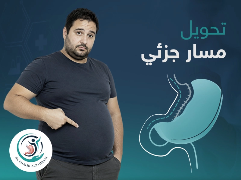 تحويل مسار جزئي